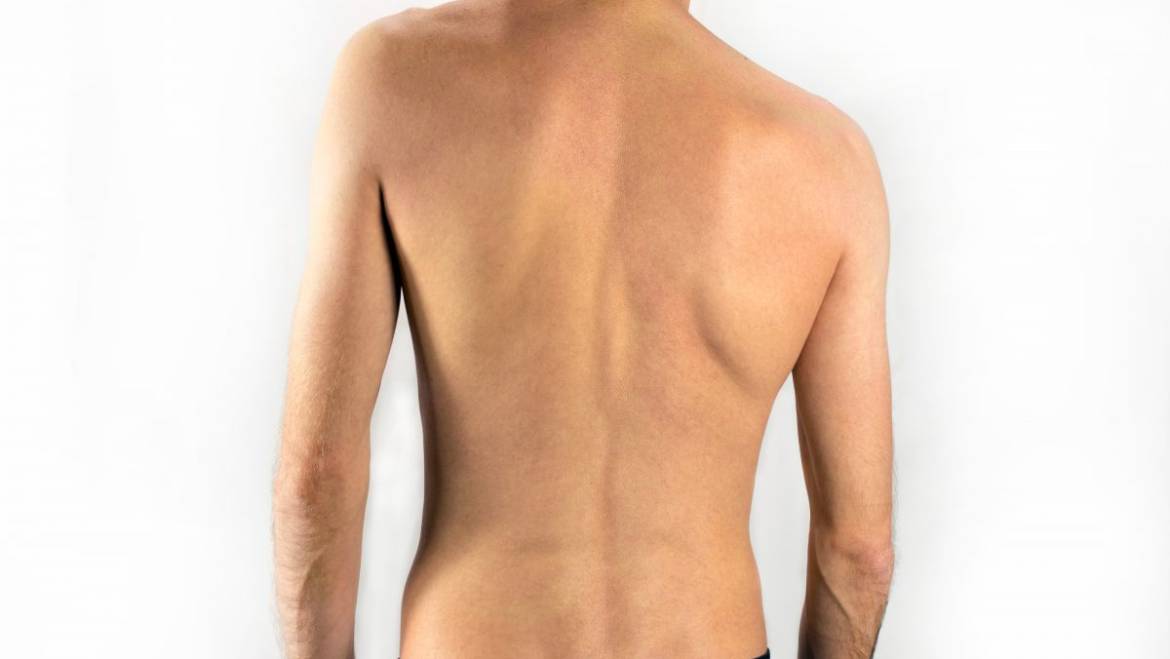 Scoliosis of the Spine: Chiropractic Management